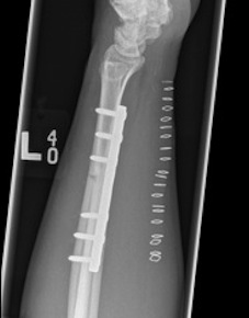 Galleazzi ORIF Lateral